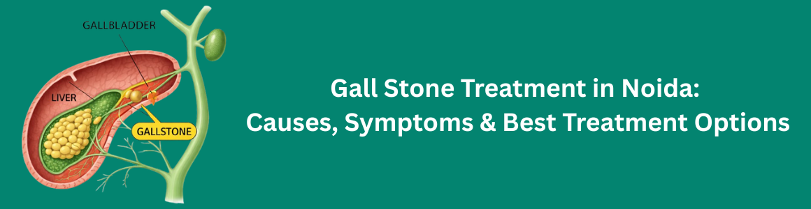 Gall Stone Treatment in Noida: Causes, Symptoms & Best Treatment Options
