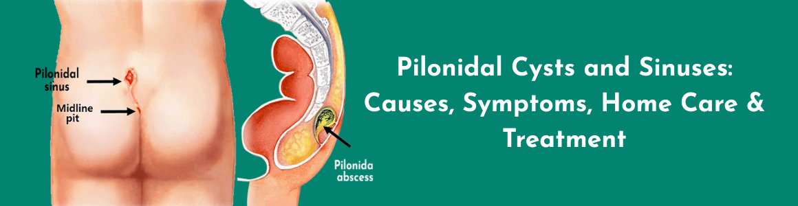 Pilonidal Cysts and Sinuses: Causes, Symptoms, Home Care & Treatment