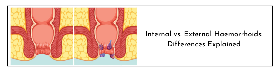 Internal vs. External Haemorrhoids: Differences Explained