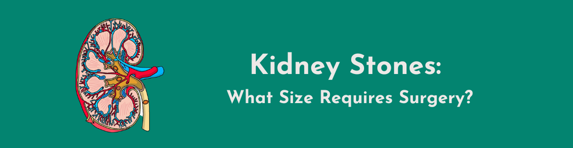 Kidney Stones: What Size Requires Surgery?