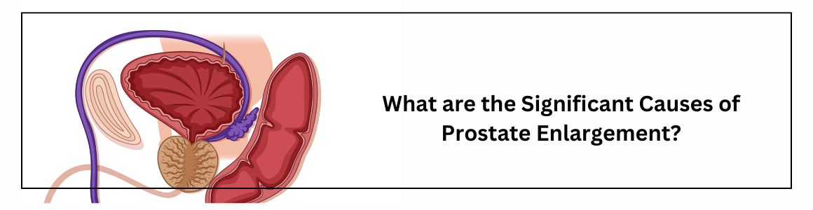 What are the Significant Causes of Prostate Enlargement?