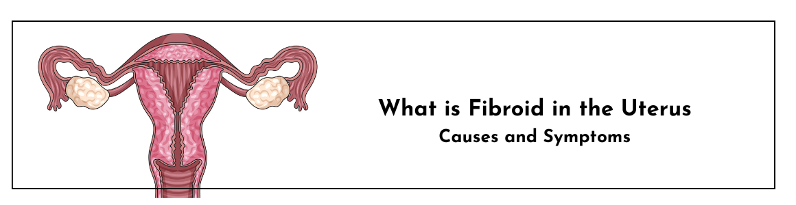 What is Fibroid in the Uterus: Causes and Symptoms