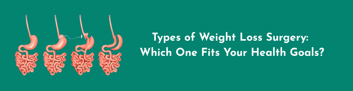 Types of Weight Loss Surgery: Which One Fits Your Health Goals?