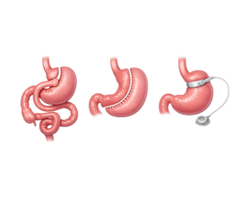 Bariatric Surgery in Delhi: Cost, Eligibility & Best Hospital Guide