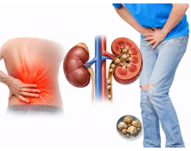 Sharp Back Pain and Burning Urination? It Could Be Kidney Stones