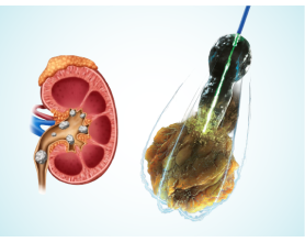Successful RIRS Laser Treatment at MASSH Delhi for a Large Kidney Stone Using 150W Holmium Laser