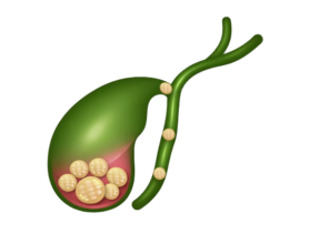 Specialist Doctor for Gall Stone Treatment in Ludhiana: Symptoms, Surgery & Care