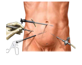 Advantages of Keyhole Surgery for Hernia Repair