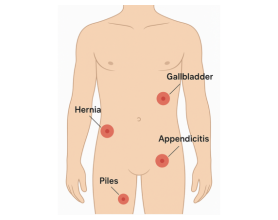 Top Surgeon in Delhi for Hernia, Gallbladder, Appendicitis & Piles