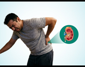 10 Early Signs of Kidney Stones You Should Never Ignore
