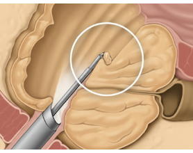 International Patient From New Zealand Visits MASSH Hospital, Delhi For Advanced HoLEP Surgery