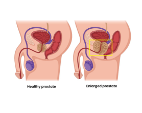 Top BPH Doctors in Delhi: Expert Care for Enlarged Prostate MASSH Hospitals