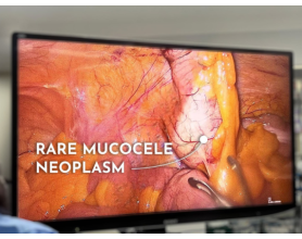 The Success of Rare Mucocele Neoplasm (LMAN) Appendix Surgery at MASSH