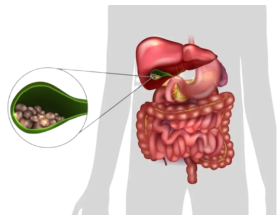 Gallstone Surgery (Cholecystectomy) in Delhi – A Complete Guide