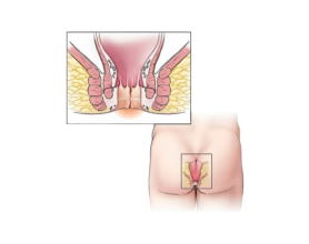 Painless Laser Fistula Treatment in Delhi - Safe & Effective Surgery