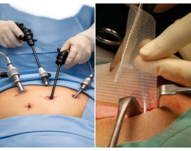Laparoscopic Hernia Surgery vs Open Surgery – Which is Safer for Patients in Delhi?