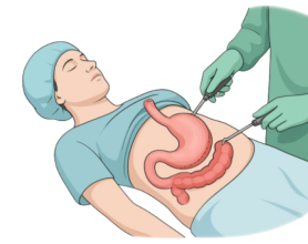 Bariatric Surgery in Delhi – Cost, Procedure & Recovery Guide