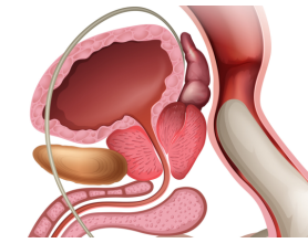 How Can I Reduce My Prostate Enlargement?