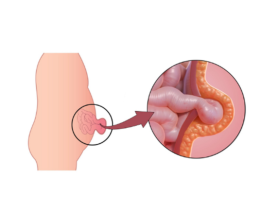 Expert Hernia Treatment in Delhi: Best Doctors & Hospitals Near You