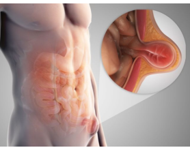 Find the Best Hernia Doctor in Delhi for Effective Treatment