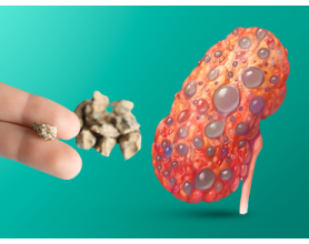 From Kidney Stones to Kidney Disease: Risks & Prevention Tips