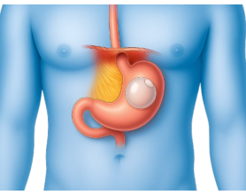 Weight Loss Ballooning Treatment in Delhi: Procedure, Benefits, and Cost