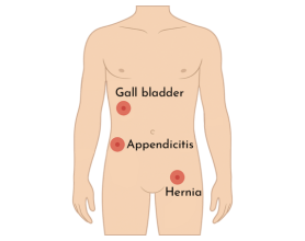Top Surgeon in Delhi for Hernia, Gallbladder, Appendicitis & Piles