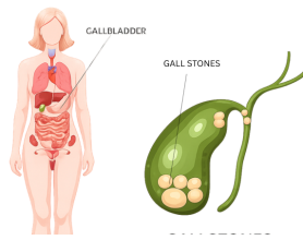 Gallstone Specialist Doctors in Noida | Safe Treatment Options