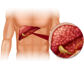 What is Gallbladder Attack? Symptoms, Treatment & Causes