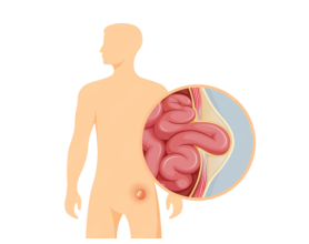 Hernia Treatment in Delhi: Early Signs, Symptoms, Costs & When to See a Doctor
