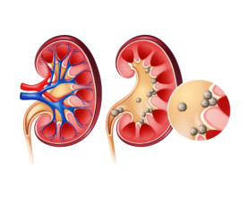 Kidney Stone Specialists Near You in Punjabi Bagh | Expert Guide to Safe Removal