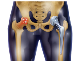 Hip Replacement Surgery in South Delhi: Best Hospitals, Surgeon, Cost & Recovery Guide
