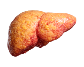 Fatty Liver Symptoms You Should Not Ignore