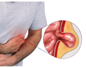 Hernia Treatment in Delhi: Best Doctors, Surgery Options & Cost Guide