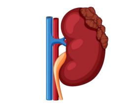 Risk Factors for Kidney Cancer: Know Your Vulnerabilities