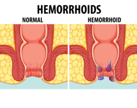 Internal vs. External Haemorrhoids: Differences Explained