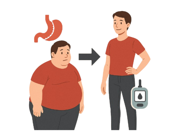 Beyond Weight Loss: How Bariatric Surgery Reverses Type 2 Diabetes