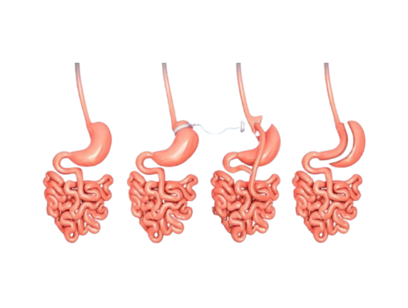 Types of Weight Loss Surgery: Which One Fits Your Health Goals?