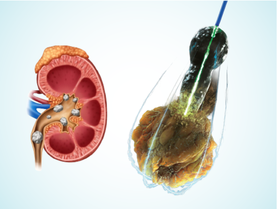 Successful RIRS Laser Treatment at MASSH Delhi for a Large Kidney Stone Using 150W Holmium Laser