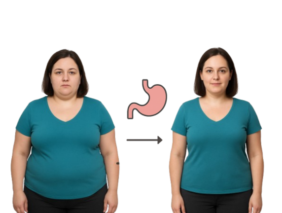 Weight Regain After Bariatric Surgery: Causes & What You Can Do