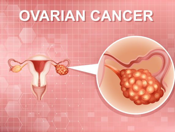 Surgical Treatment For Ovarian Cancer: Empowering Women’s Health Through Precise Medical Procedures