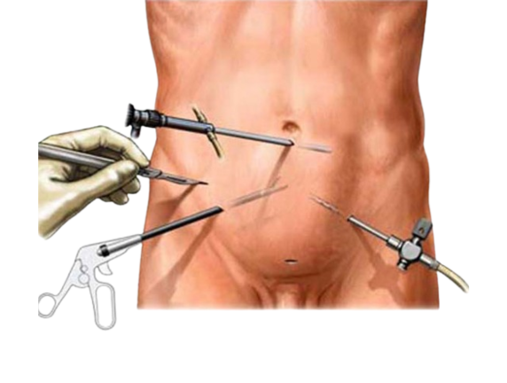 Advantages of Keyhole Surgery for Hernia Repair