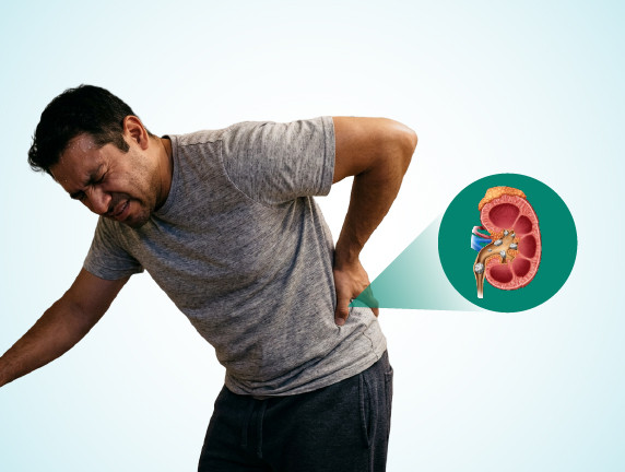 10 Early Signs of Kidney Stones You Should Never Ignore