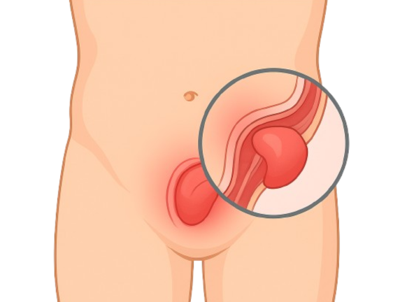 Short Stay Hernia Surgery in Delhi – Treatment and Discharge in 24 hours