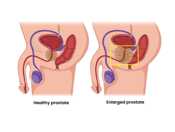 Top BPH Doctors in Delhi: Expert Care for Enlarged Prostate MASSH Hospitals