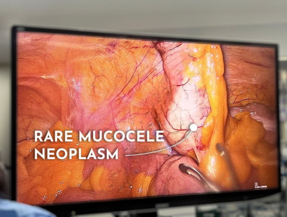 The Success of Rare Mucocele Neoplasm (LMAN) Appendix Surgery at MASSH