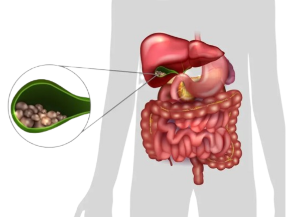 Gallstone Surgery in Delhi Through Minimally Invasive Techniques