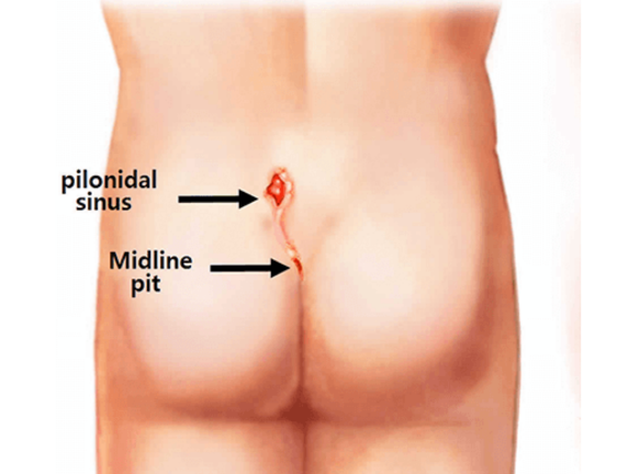 Pilonidal Cysts and Sinuses: Causes, Symptoms, Home Care & Treatment