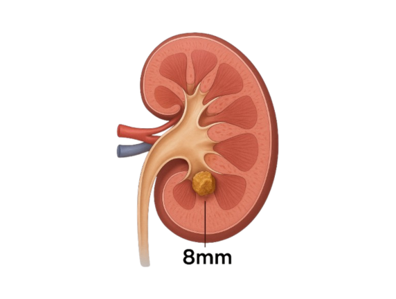 Is an 8mm Kidney Stone Serious? What You Need to Know