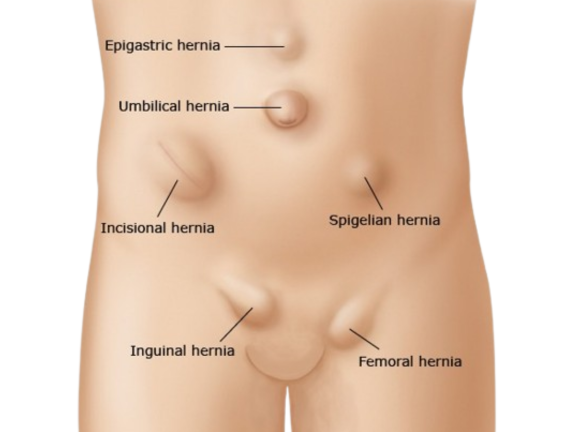 Hernia Treatment in Delhi: Meet the Best Doctors for Your Care